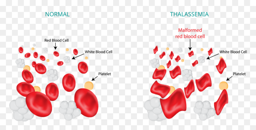 Thalassemia Blood Cells, HD Png Download - red blood cells png