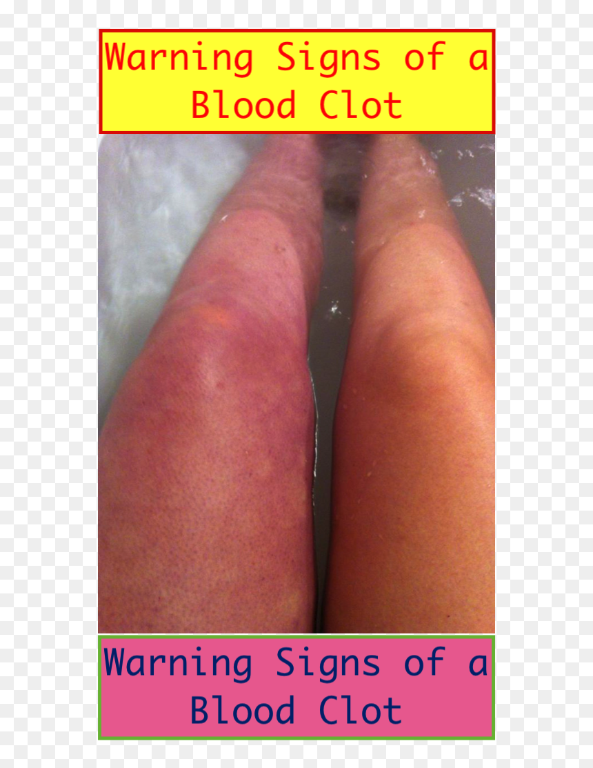 Photo Caption, HD Png Download - blood cut png