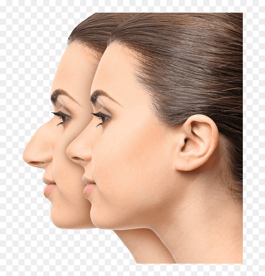 Modelos De Nariz Para Rinoplastia , Png Download - Nose Rhinoplasty, Transparent Png - nariz png