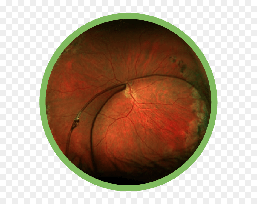 Complex Anterior Segment Disease - Fumari Tobacco Logo, HD Png Download - eye lens flare png