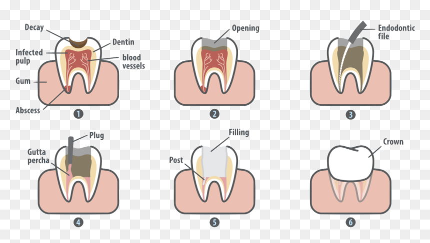 Tooth Clipart Crown Image Transparent Root Canal In - Root Canal Pain, HD Png Download - tooth.png
