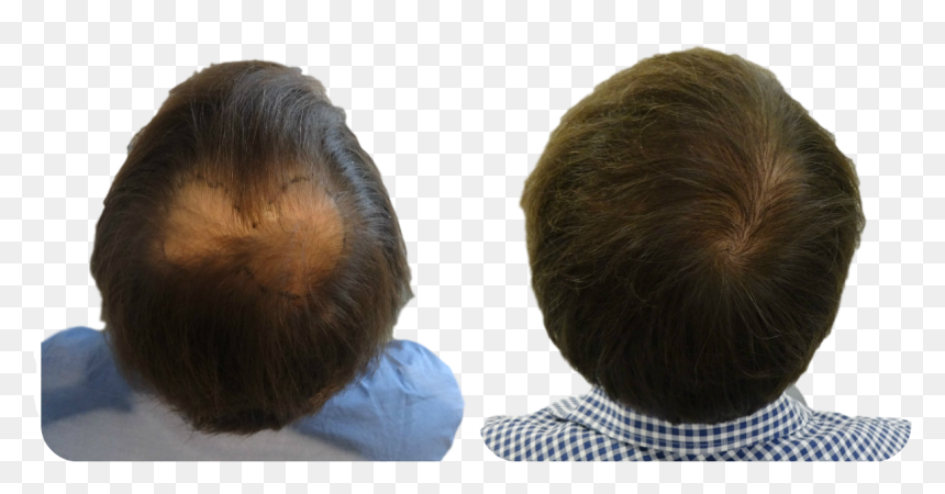 Fue Hair Transplant Scalp, HD Png Download - hair with bangs png