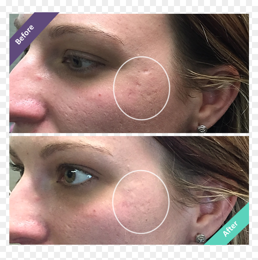 Filler For Ice Pick Scars, HD Png Download - face scar png