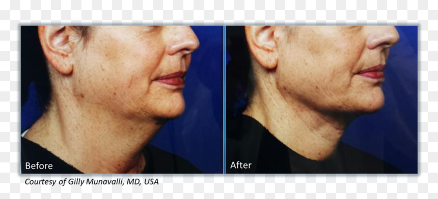 Screenshot, HD Png Download - face scar png