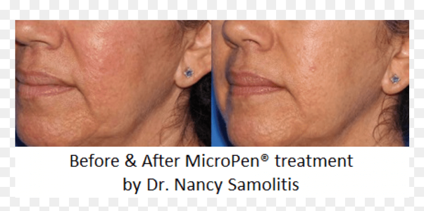 Earrings, HD Png Download - face scar png