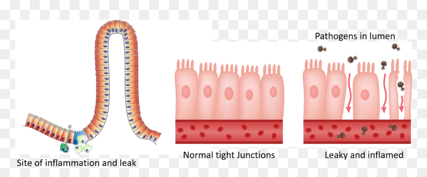 Leaky Gut, HD Png Download - small intestine png