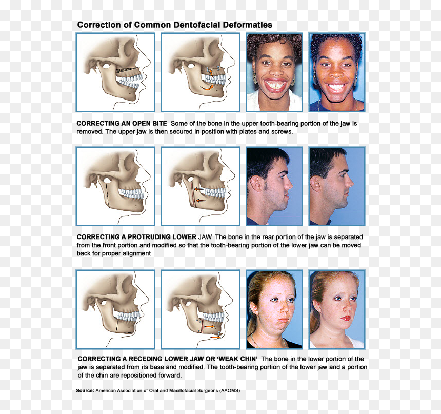 Jaw Alignment Surgery, HD Png Download - jaw png