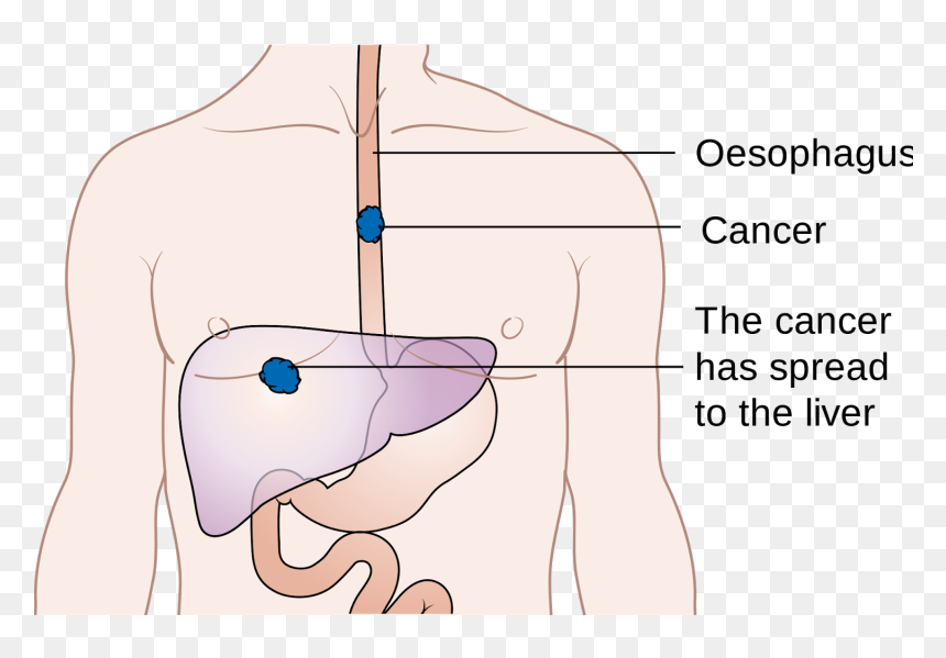 Am Worried About Esophagus Cancer, HD Png Download - esophagus png
