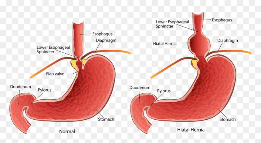 Minor Hiatal Hernia, HD Png Download - esophagus png